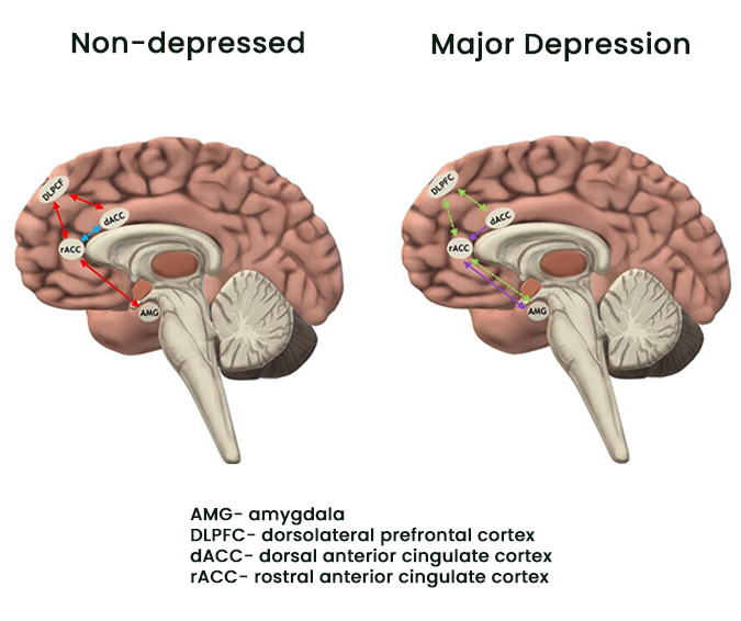 Chronic Depression: 